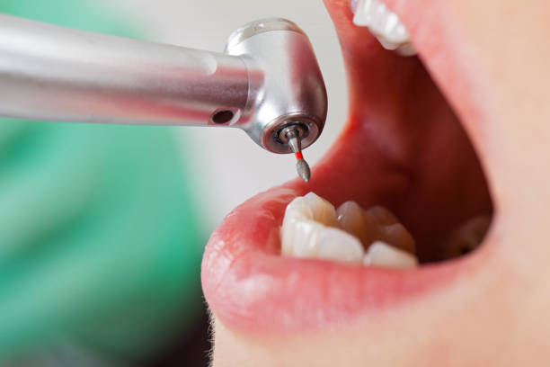 Best Emergency Wisdom Teeth Removal in Whitney, SC